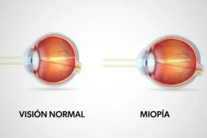 ojo normal y ojo con miopia