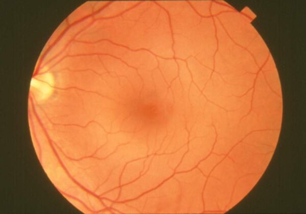 retina humana